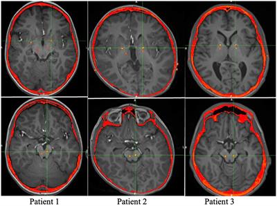 Novel utilization of deep brain stimulation in the pedunculopontine nucleus with globus pallidus internus for treatment of childhood-onset dystonia
